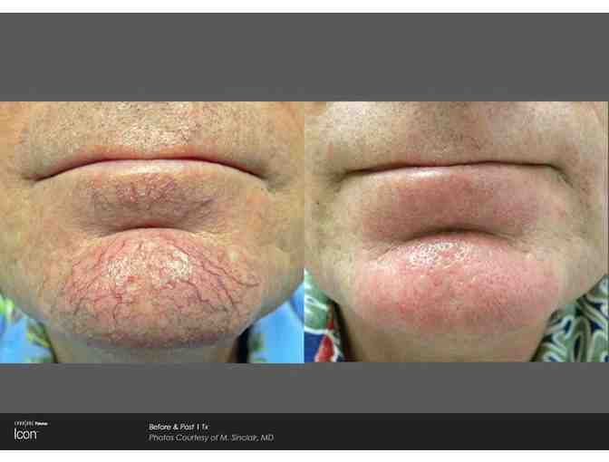 Laser Treatment by Dr. Summer Chong at Oahu Dermatology (Oahu)