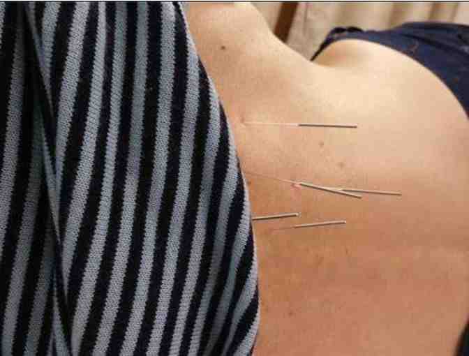 Alma Acupuncture - Oakland CA