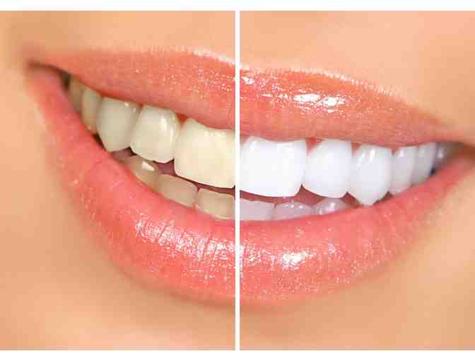 Teeth Whitening and Night Guard