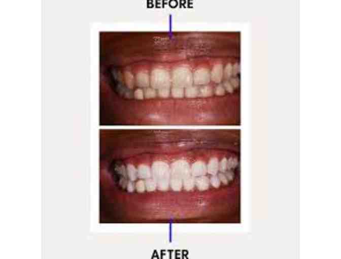 Ideal Dental - Teeth whitening treatment