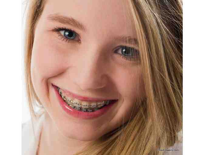 SUMMER ORTHODONTICS FULL SET OF BRACES