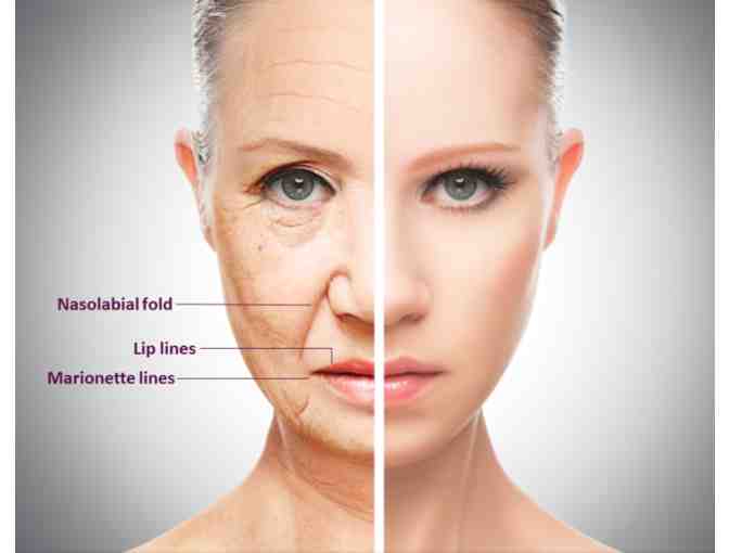 Derma Filler - 2 areas from Fix Me Up Med Spa
