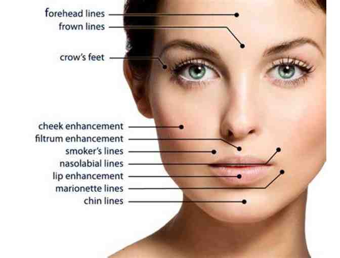 Derma Filler - 2 areas from Fix Me Up Med Spa
