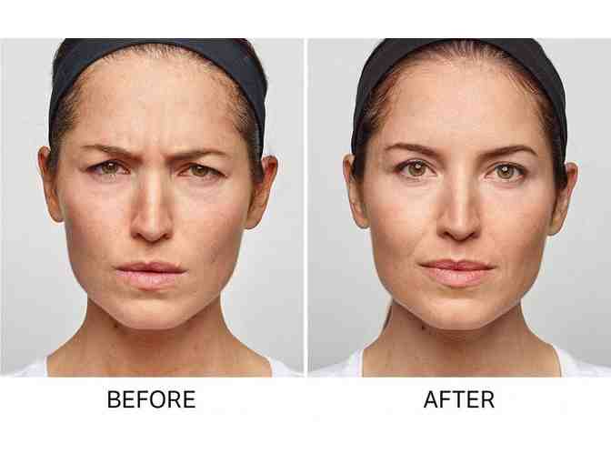 90 Units of Dysport For In Between Eyebrow Frown Lines