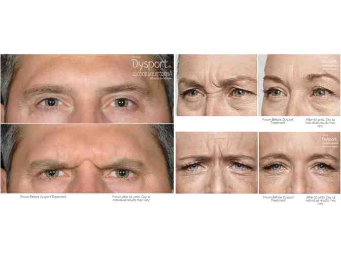 90 Units of Dysport For In Between Eyebrow Frown Lines