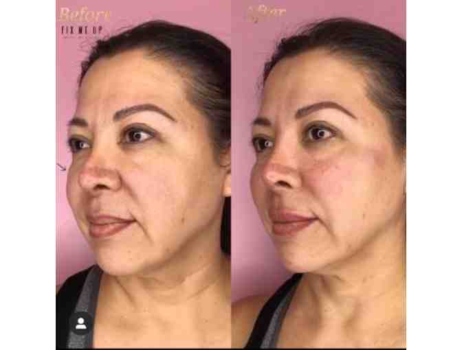 Derma Filler - 2 areas from Fix Me Up Med Spa