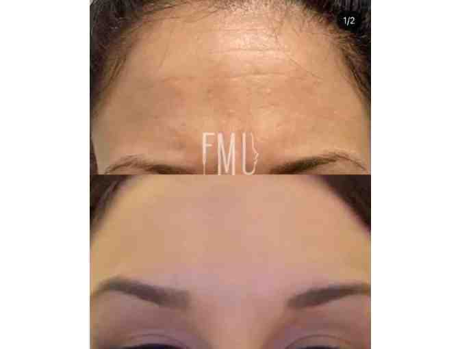 Derma Filler - 2 areas from Fix Me Up Med Spa