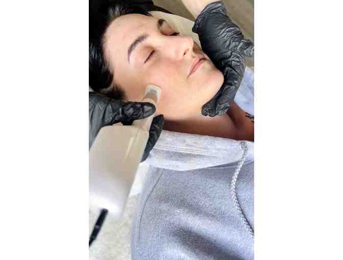 Jet Plasma or Plasma Fibroblast Skin Treatments at Volta Plasma Studio