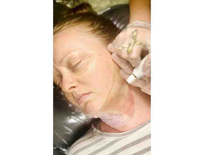 Jet Plasma or Plasma Fibroblast Skin Treatments at Volta Plasma Studio