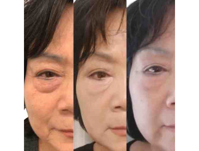 In-Home Med Spa - Non-Surgical Facelift with No Downtime