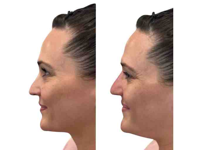 In-Home Med Spa - Non-Surgical Facelift with No Downtime