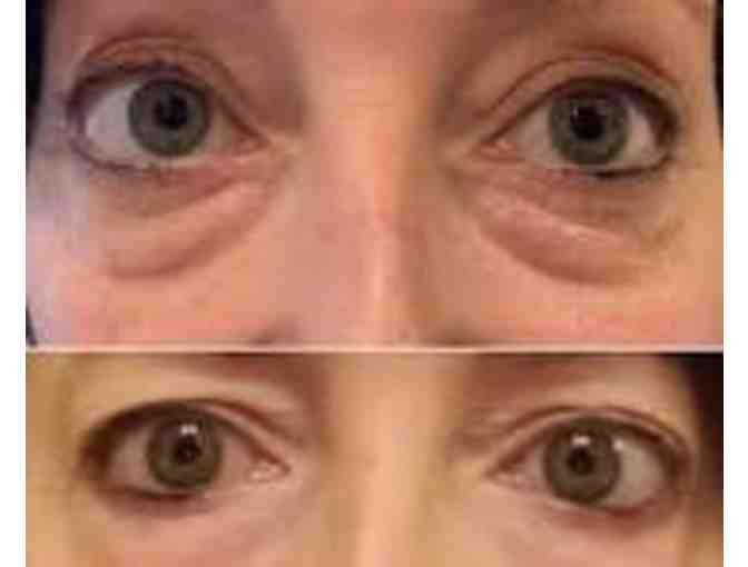 In-Home Med Spa - Non-Surgical Facelift with No Downtime