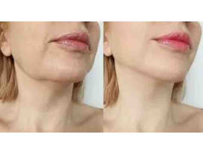 In-Home Med Spa - Non-Surgical Facelift with No Downtime